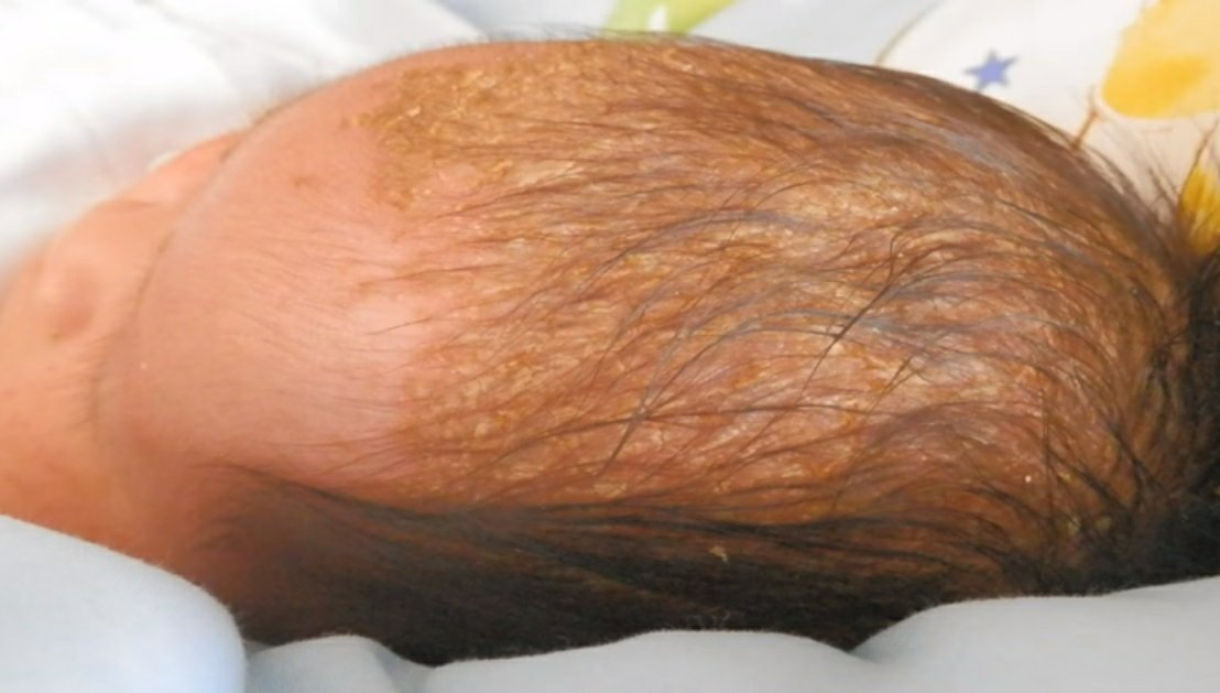 Cradle cap Stop worrying about the scaly rash on your baby's scalp